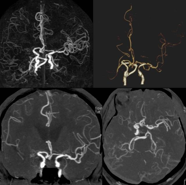 强力定眩片专治什么病_强力定眩片多少钱一盒_强力定眩片能长期吃吗