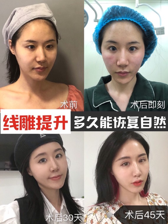 朋友做蛋白线提升_美即(弹力蛋白)提升紧致眼膜_蛋白埋线提升后悔