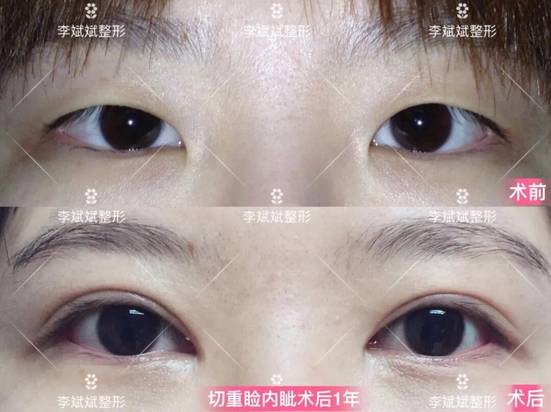 沈阳哪家做双眼皮好_沈阳哪里做双眼皮好_沈阳做无痛人流哪个医院好