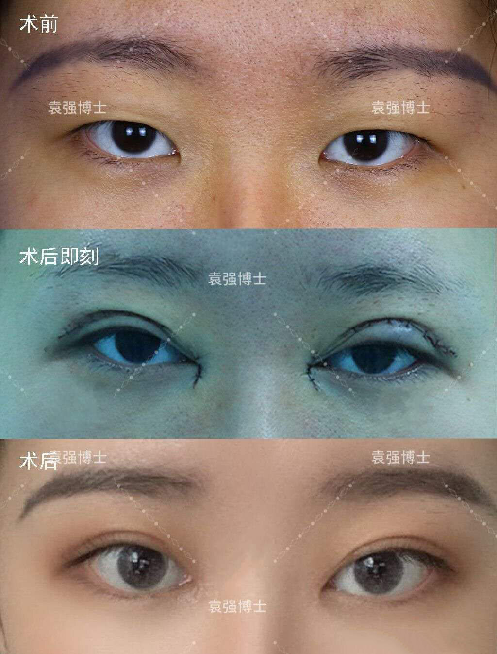 沈阳哪家做双眼皮好_沈阳哪里做双眼皮好_沈阳做无痛人流哪个医院好