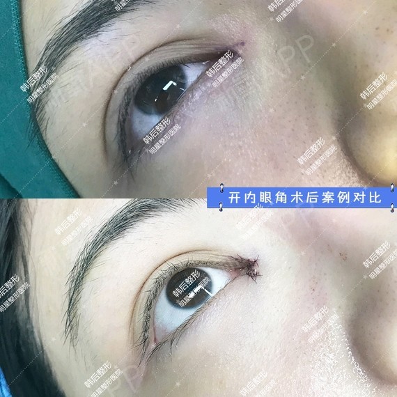 双眼皮面诊需要素颜吗_在开双眼皮需要多少钱_开眼角做双眼皮的女明星