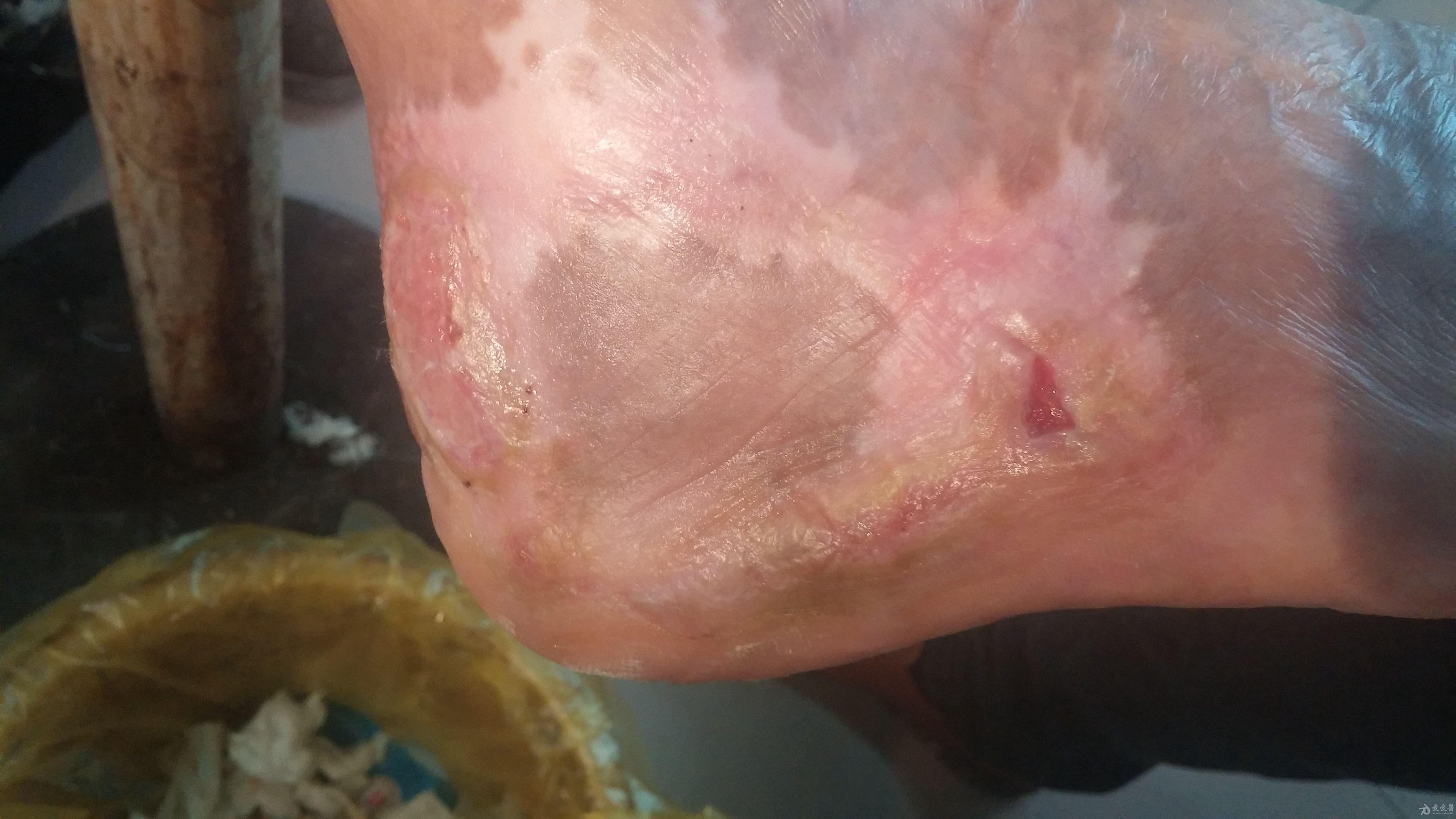 乳房靠近腋下的皮肤上长小肉粒_热水代烫伤后长不上新肉怎么办_屁眼上长了个肉球会传染她人吗
