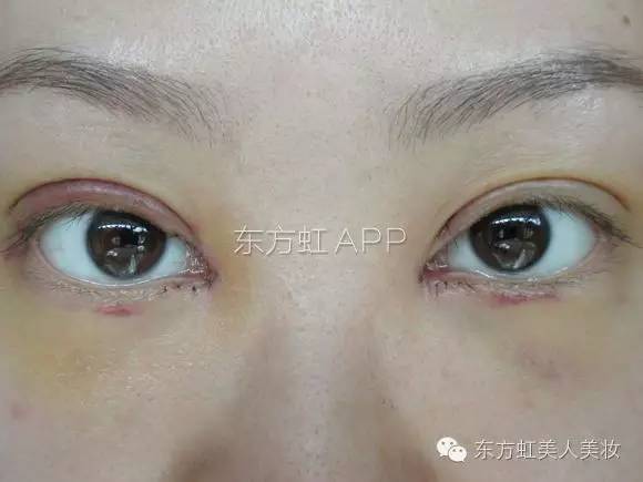 双眼皮三点定位做法_环形定位双眼皮的过程_三点定位双眼皮蛋白线