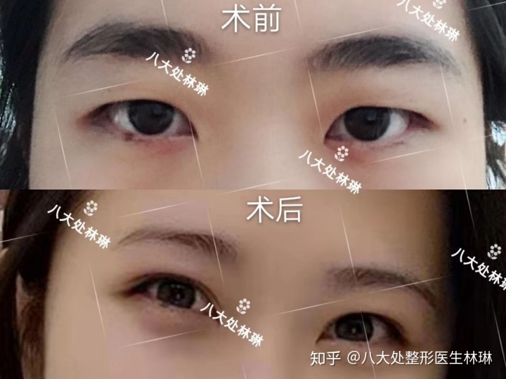 做双眼皮的最佳时间段_螺丝田最佳欣赏时间点_做双眼皮的最佳时间点