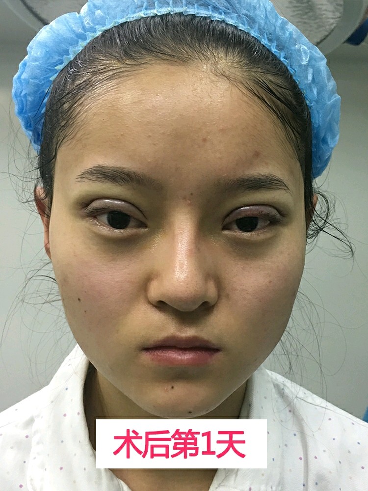 面试后应注意哪些事项_激光点痣后需要注意什么事项_做好双眼皮后注意事项