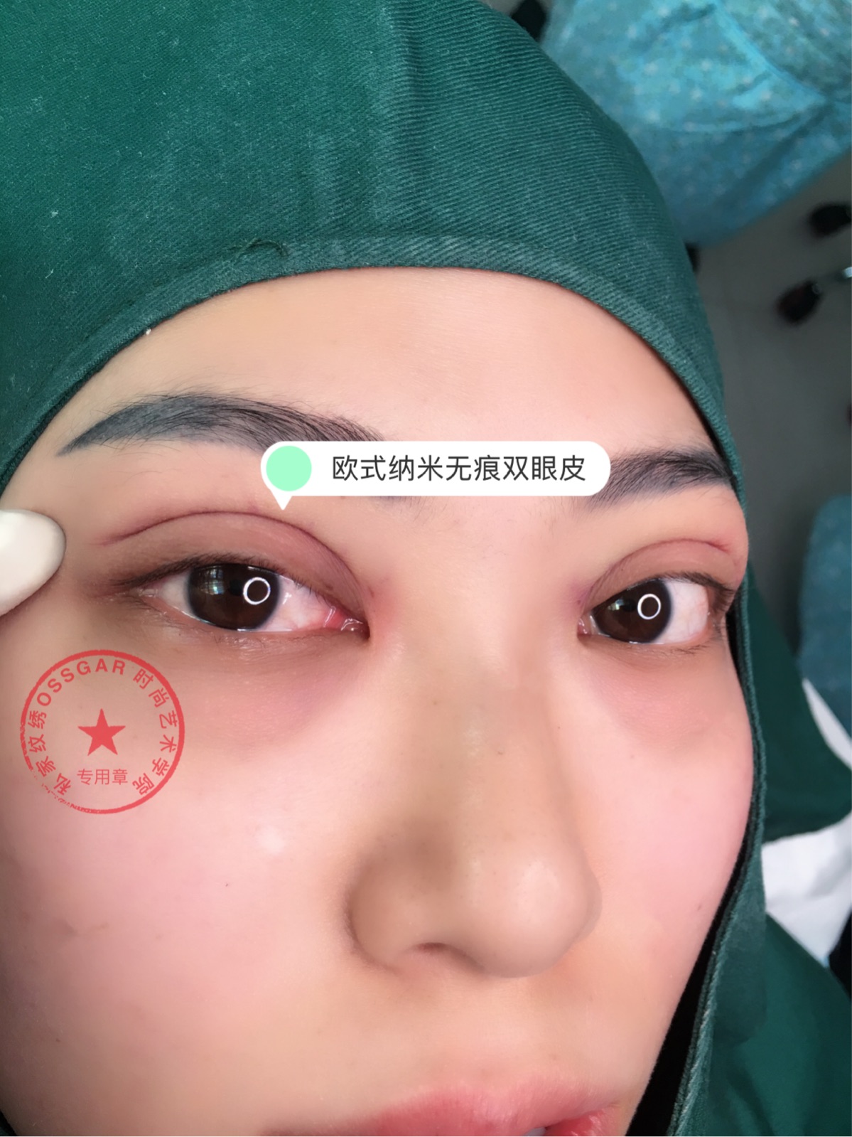 做好双眼皮后注意事项_面部吸脂后注意哪些事项_激光后注意哪些事项呢