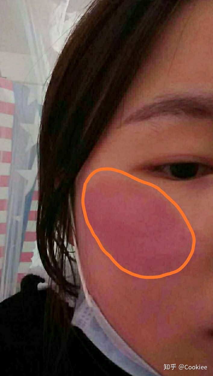 打猎圆皮好还是扁皮好_手臂吸脂多久可以恢复好_拉皮多久可以恢复好