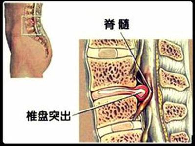 香港腰椎间盘突出药油_腰椎健盘突出怎么治疗_治疗腰椎肩盘突出医院