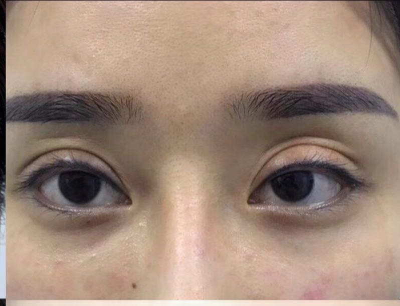 双眼皮做法的不一样大怎么办_卵巢皮样囊肿_皮样囊肿危险吗