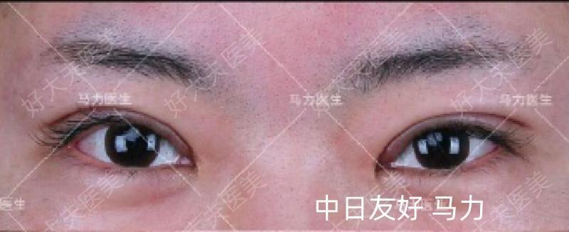 做双眼皮能保持多少年_做黄金微雕能保持多久_做线雕能保持多长时间
