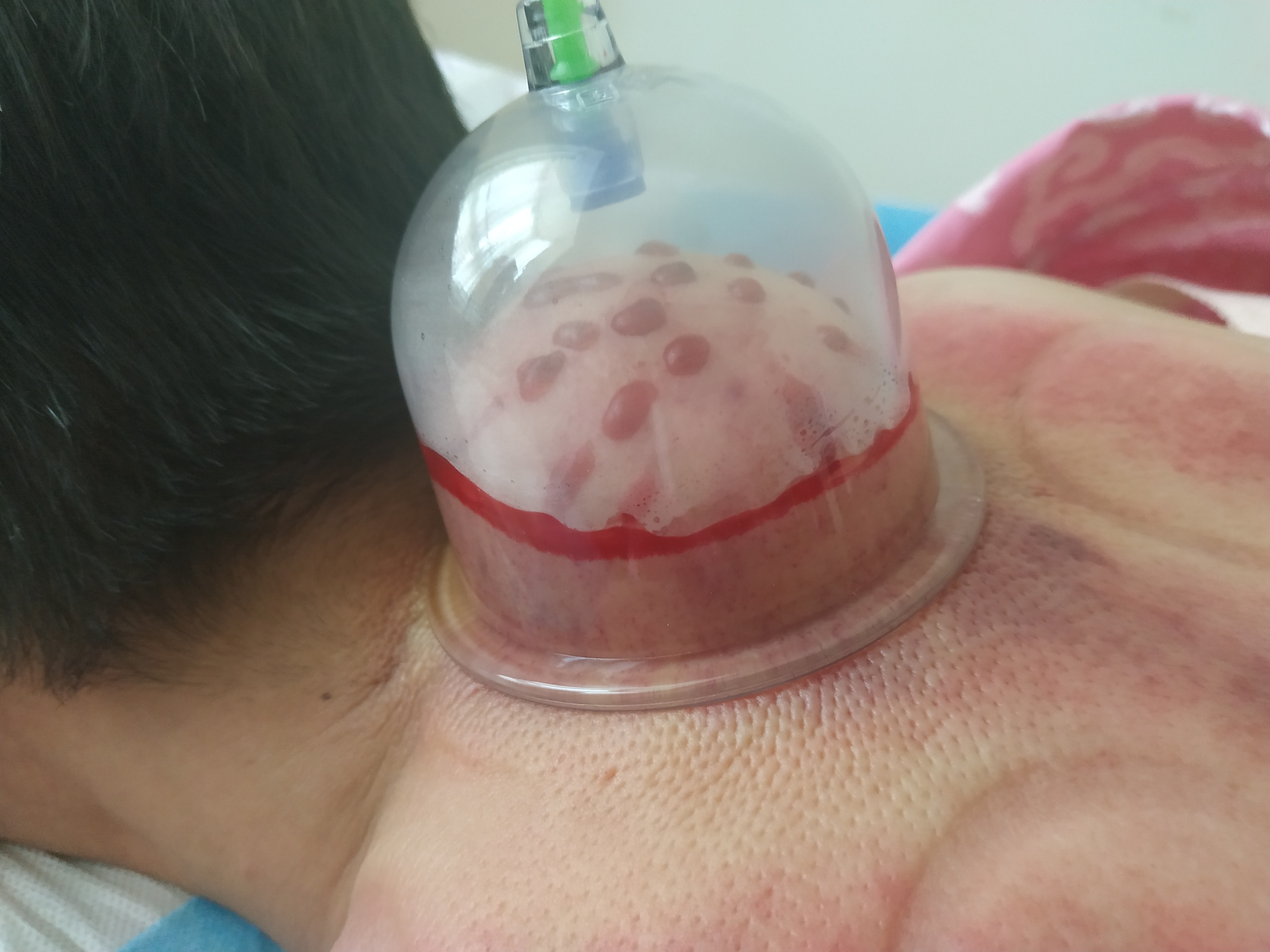 颈椎拨罐后是紫色好吗_真空拨罐后会出现紫色_伏天拨罐须要拨多少天