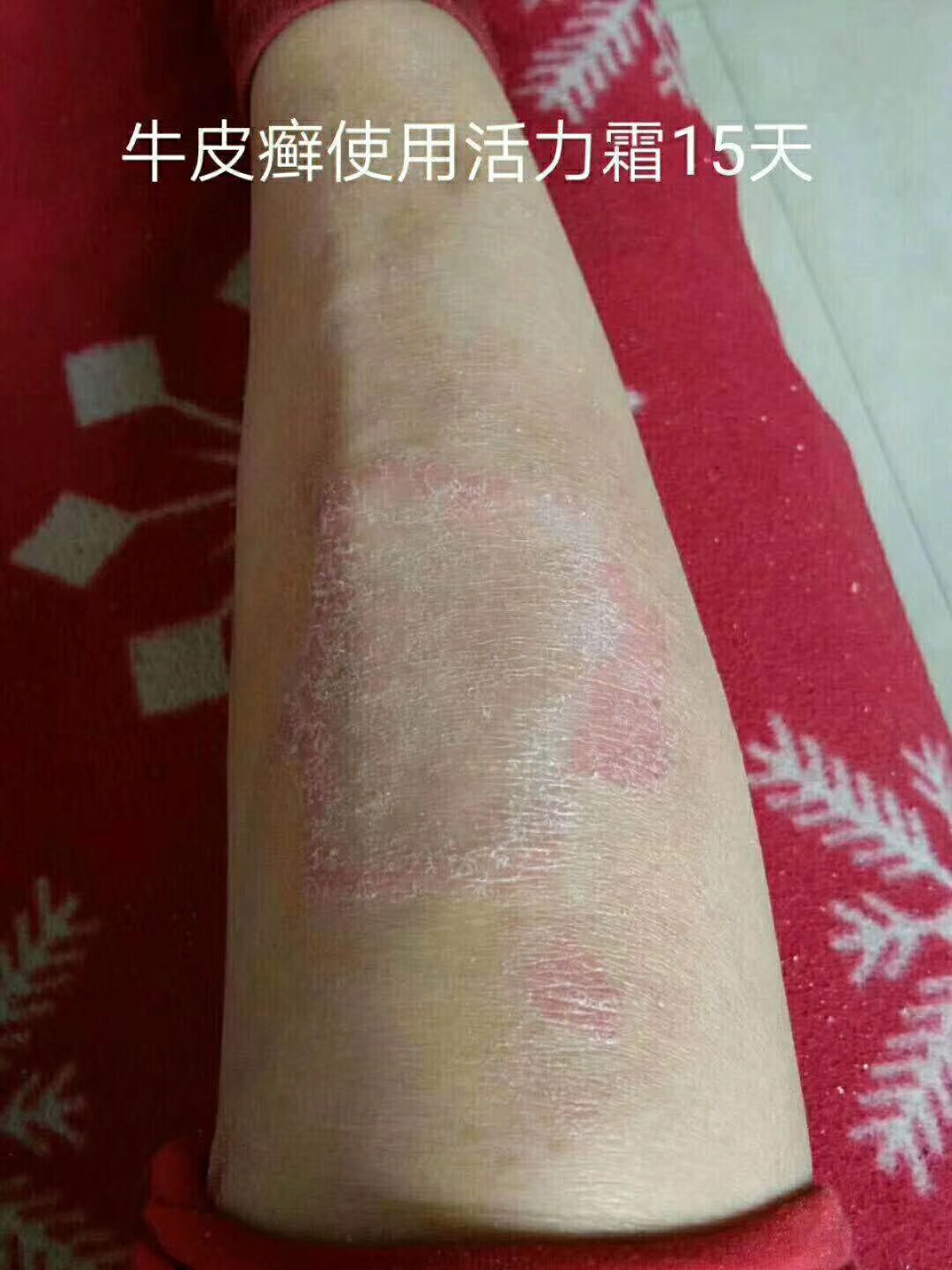 怎么去脸上的黑印_葫芦上的黑印怎么去_去黑印是维生素几