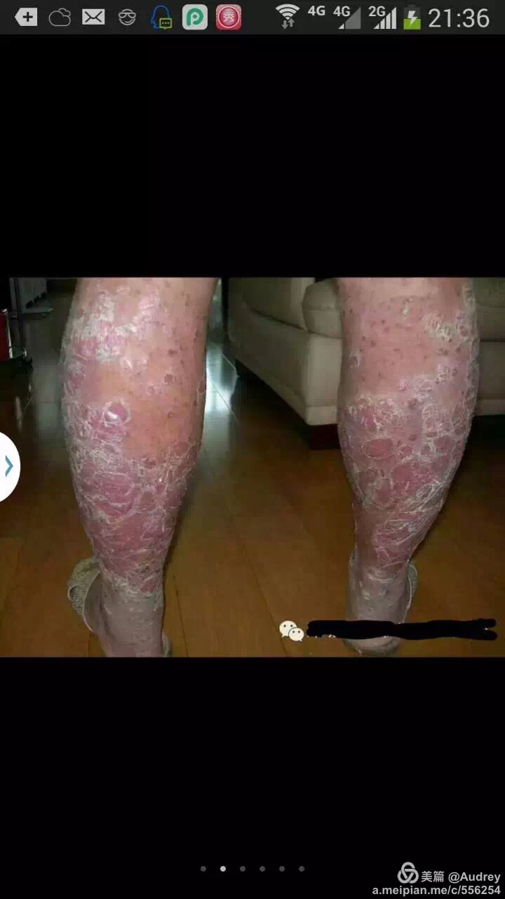 葫芦上的黑印怎么去_怎么去脸上的黑印_去黑印是维生素几