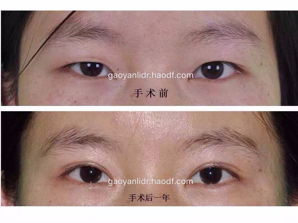 一般说什么蒙蔽了双眼_什么皮材质做钱包好_一般做个最低的双眼皮多少钱啊