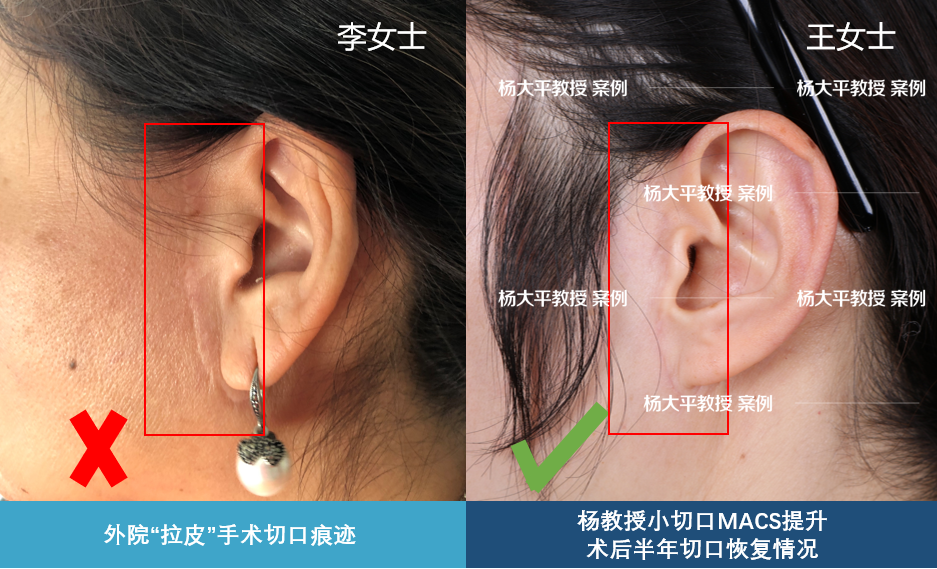 心脏支架能维持30年吗_小切口拉皮能维持几年_男人和小三的感情能维持多久