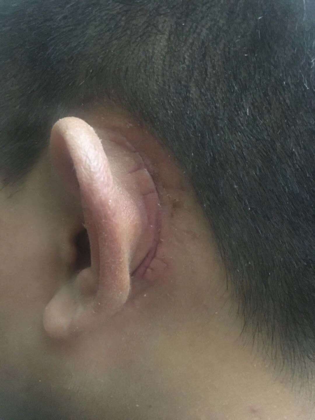 男人和小三的感情能维持多久_小切口拉皮能维持几年_皮秒激光祛斑维持多久