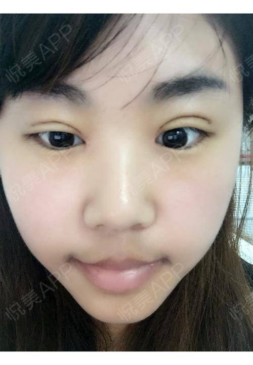 割双眼眼皮一星期图片6_割双眼开眼角价格_郑州割双眼皮哪好标准化领