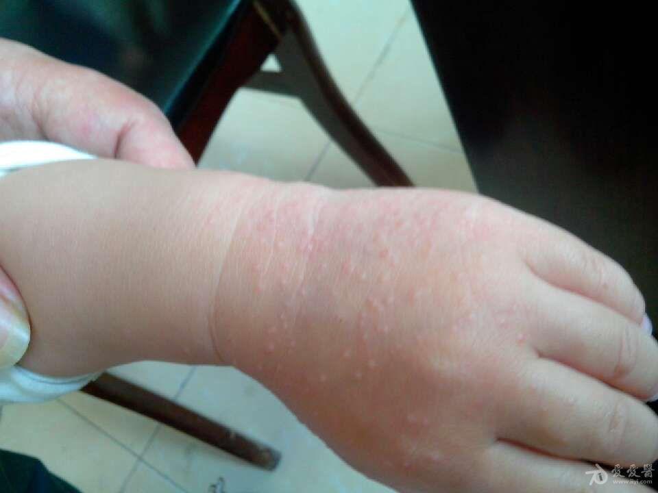 眼皮上长了个肉粒图片_小孩手臂长小米粒图片_小孩眼皮上长了个小肉粒怎么办