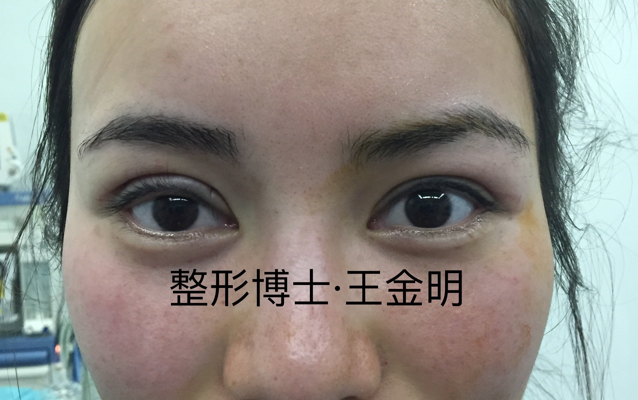 徐州哪里双眼皮技术好_徐州哪个医院做无痛人流技术好_哈市哪家医院做双眼皮开眼角好