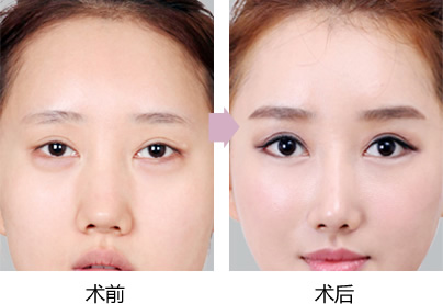 徐州哪个医院做无痛人流技术好_哈市哪家医院做双眼皮开眼角好_徐州哪里双眼皮技术好
