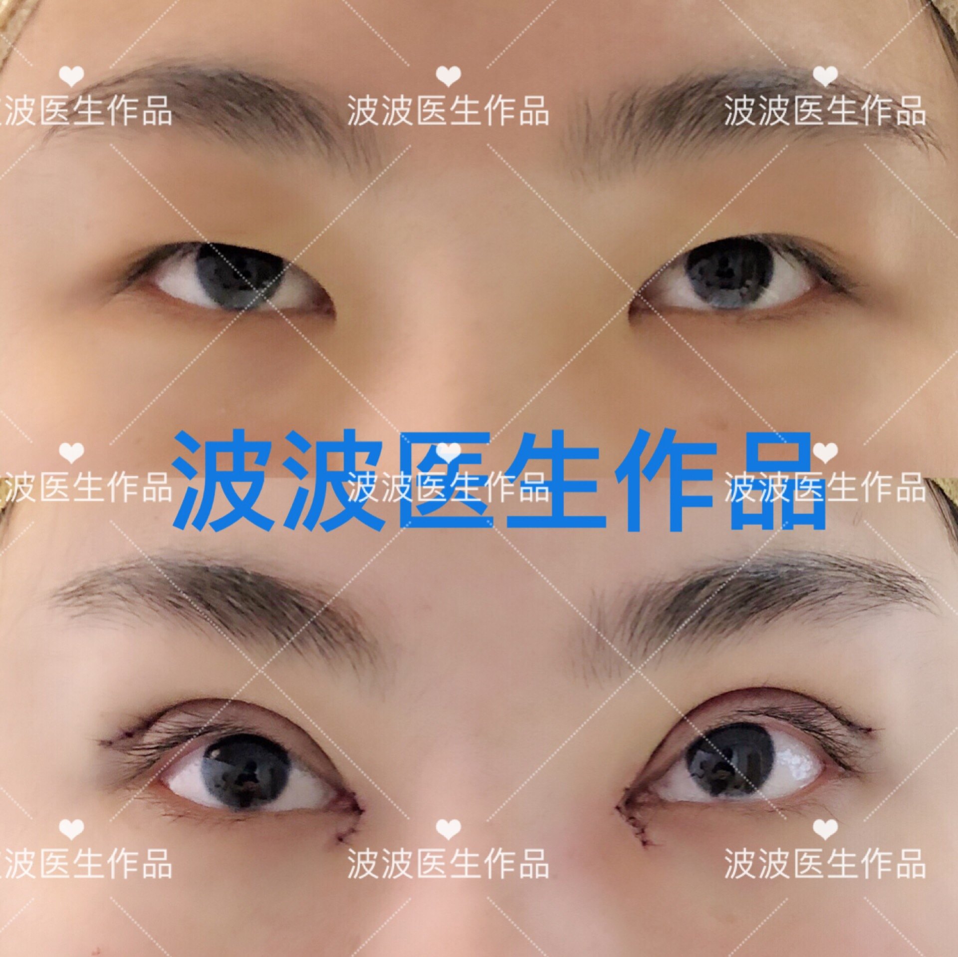 埋线双眼皮线会完全吸收的_订书针双眼皮会掉落_双眼皮内眦皮