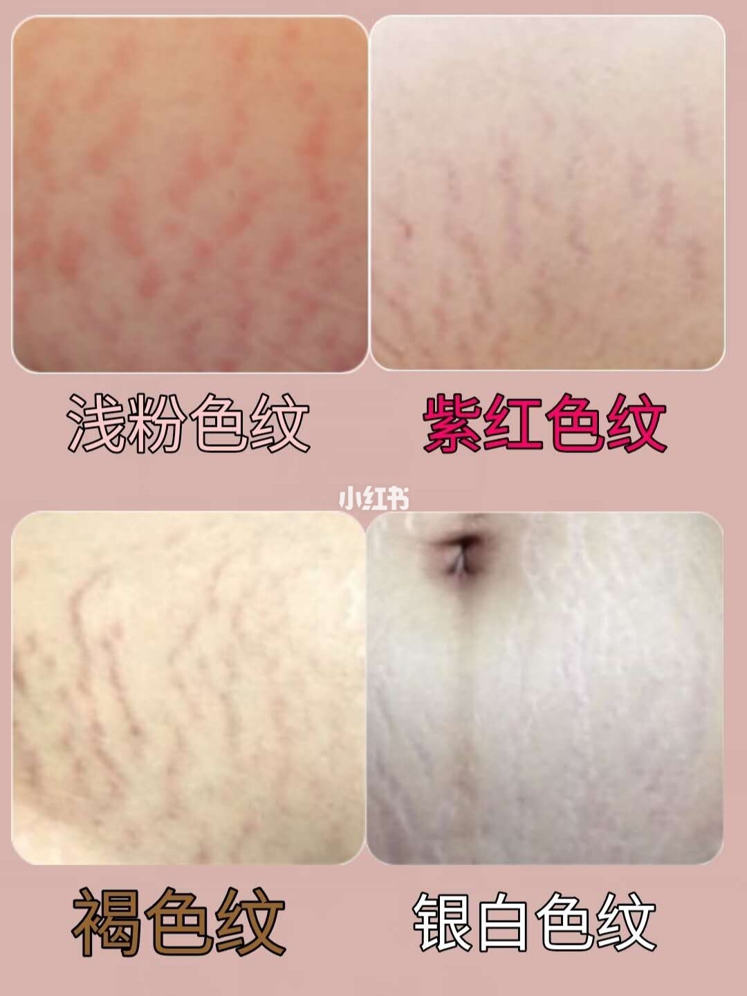 日本人用的去妊娠纹产品_韩国去妊娠纹产品_去妊娠纹用什么产品好