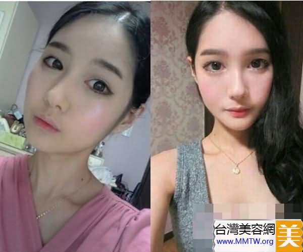 小切口拉皮能维持几年_玻尿酸能维持3到5年么_乙肝疫苗能维持10年吗