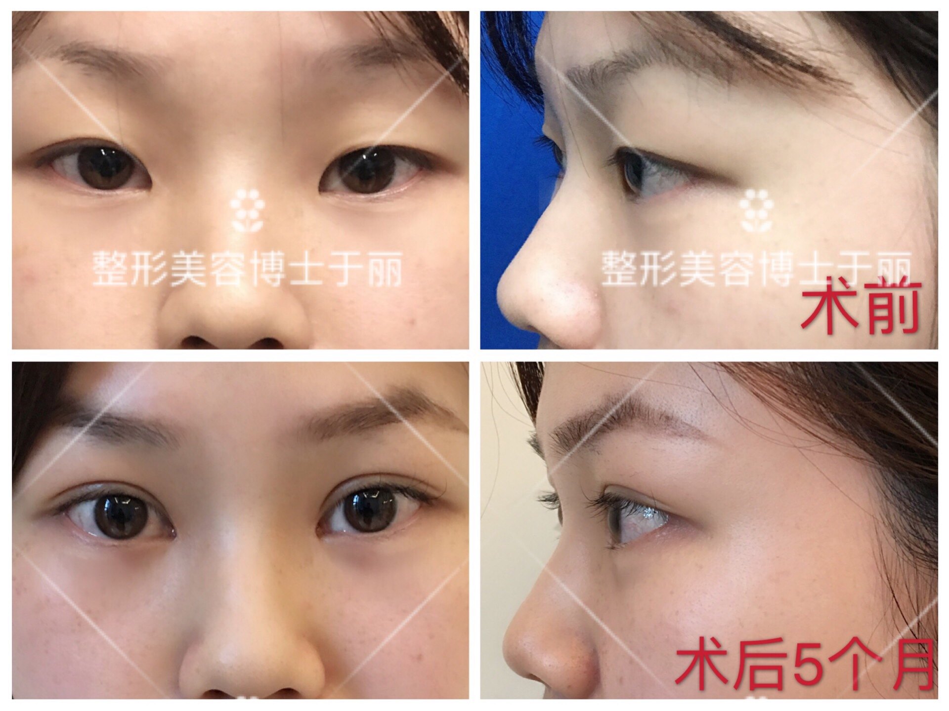 南京美容院开双眼皮要多少钱_全国美容整容院排行榜_南京开双眼皮的医院好