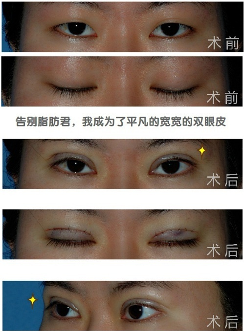 杭州做双眼皮的正规医院_莱州人民医院做双眼皮价格_上海市做双眼皮的医院