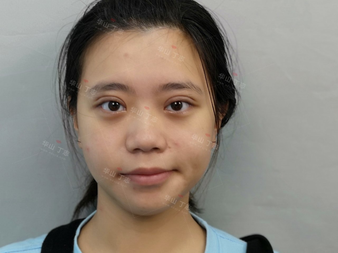 双眼皮修复上海美来l医院_双眼皮修复上海美来l安全_切双眼皮上海美来l强