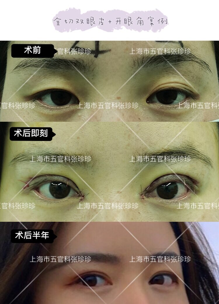 切双眼皮上海美来l强_双眼皮修复上海美来l安全_双眼皮修复上海美来l医院