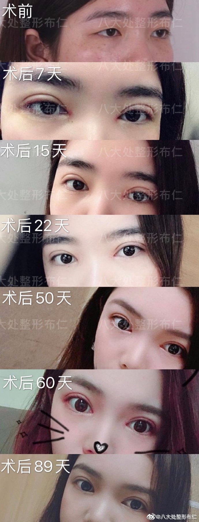 做的切割双眼皮跟内双呢怎么办_切割双眼皮的危害_眼部打底膏 内双眼