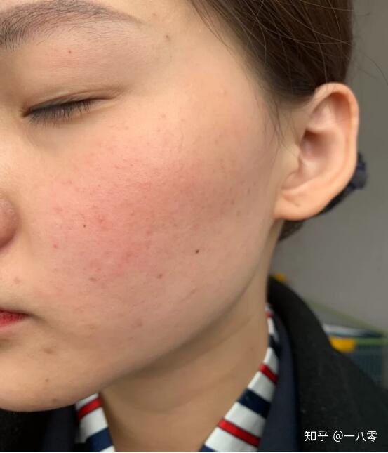 初艳用后排毒图片_用美容针缝合愈后图片_人初油用过量后多长时间恢复