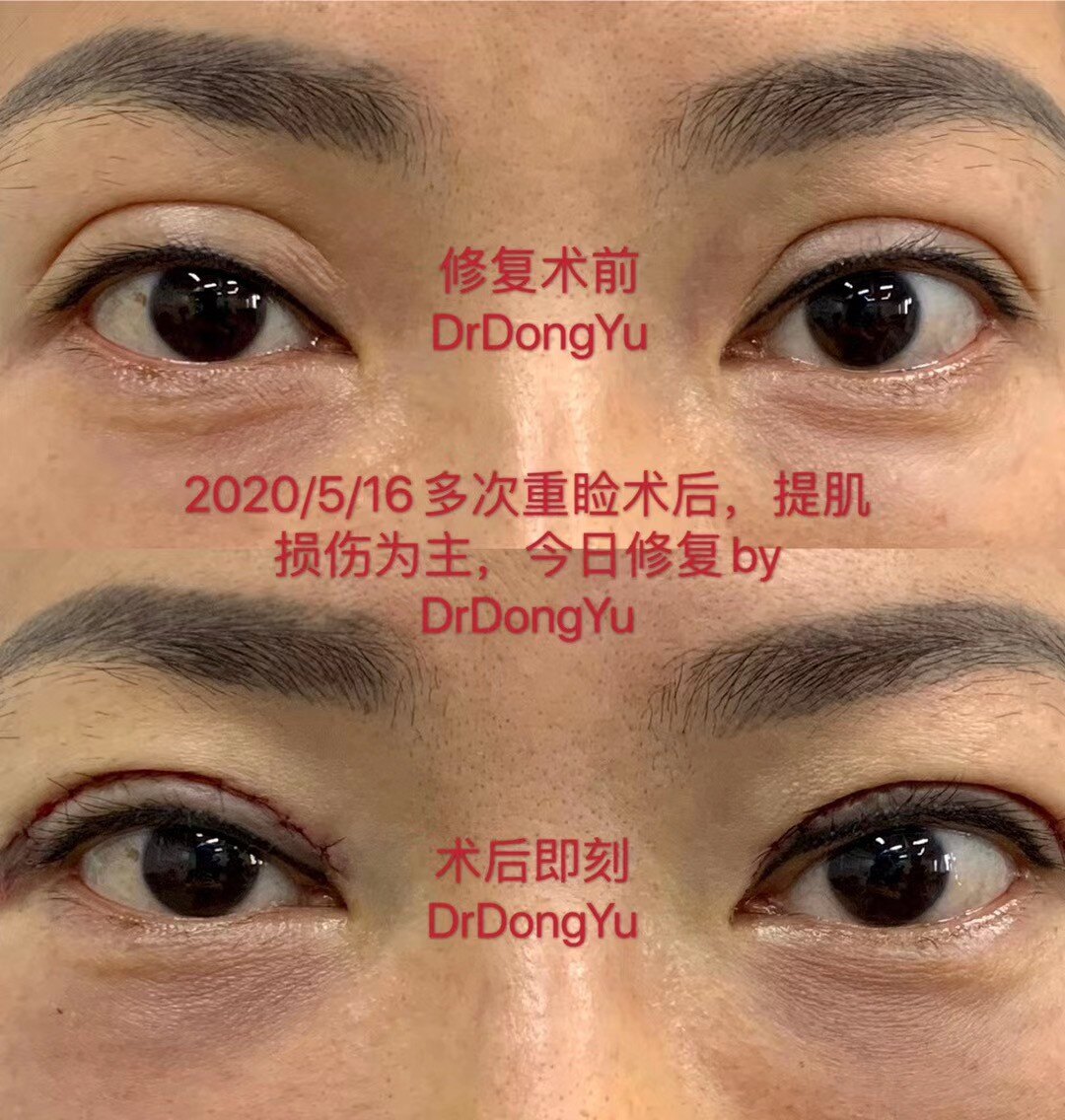 沈阳做双眼皮最好_哈市哪家医院做双眼皮开眼角好_双眼皮内眦皮