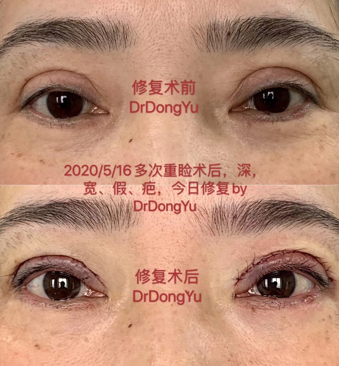 哈市哪家医院做双眼皮开眼角好_双眼皮内眦皮_沈阳做双眼皮最好