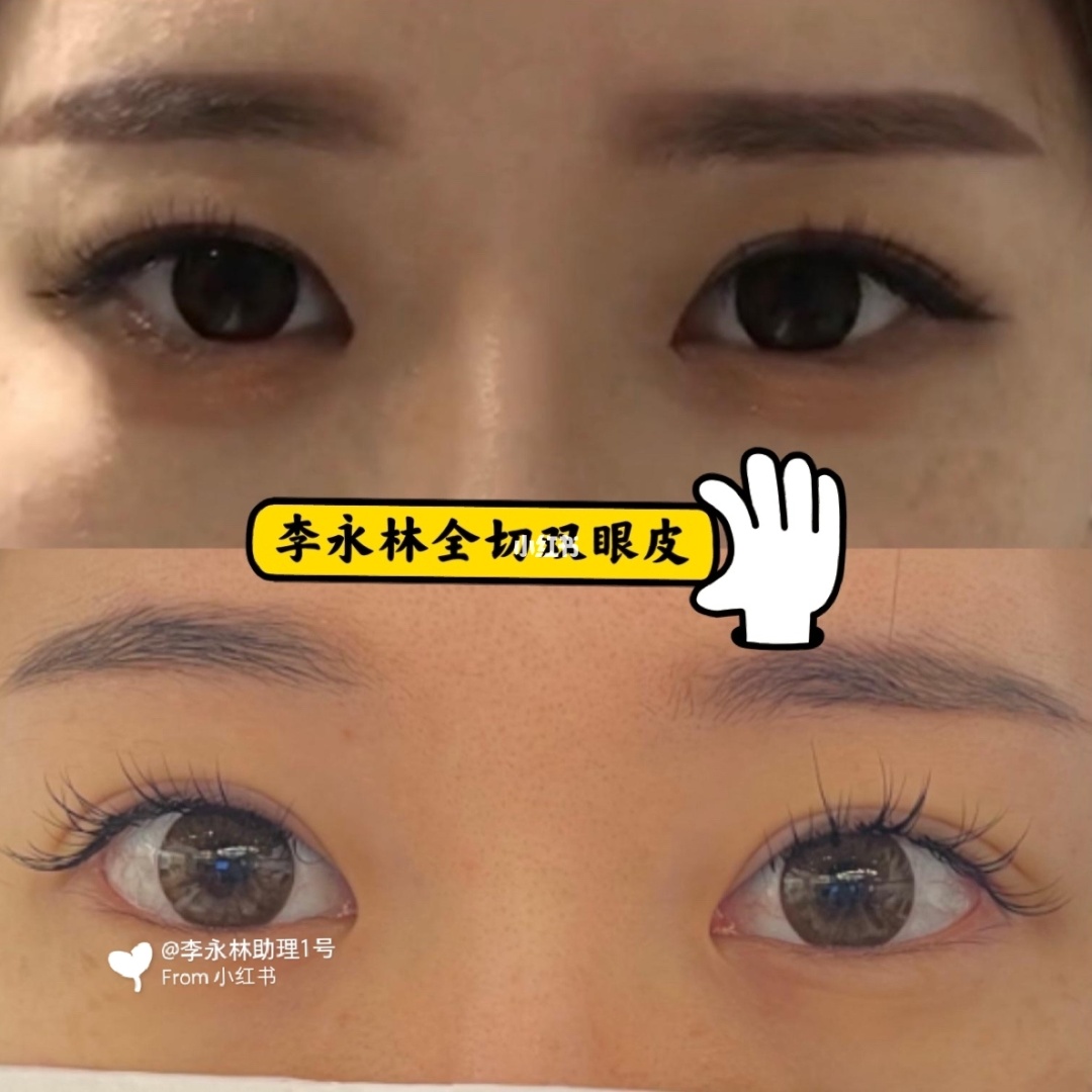 菜粿皮要怎样才可以做_做双眼皮要价格表_才做双眼皮的十天照片