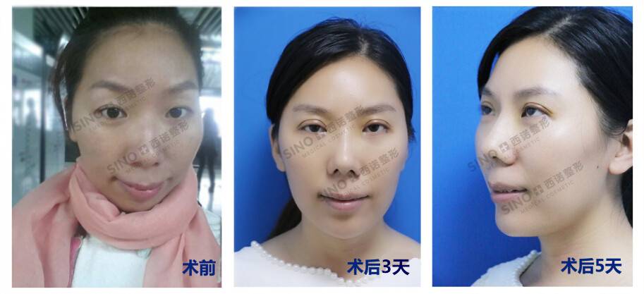 山东专业做双眼皮的医院_沈阳做双眼皮价格_沈阳做输卵管造影价格