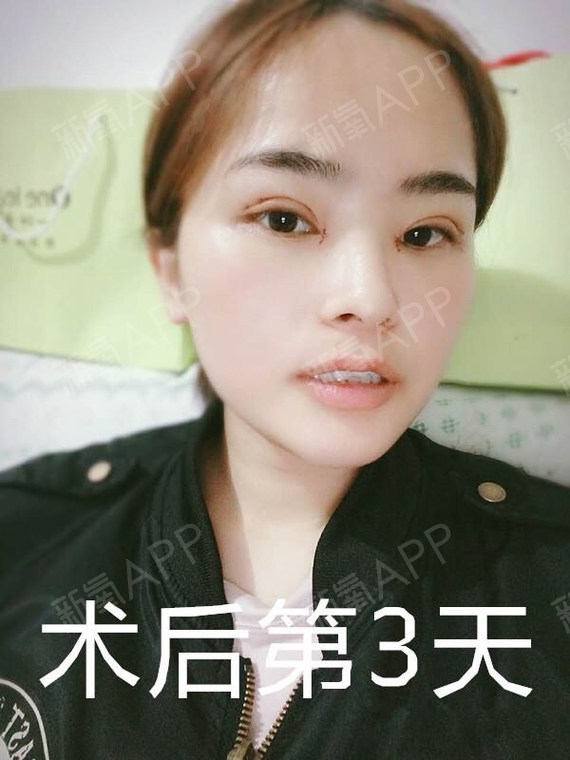 沈阳做流产价格_沈阳艾咪拉双眼皮开眼角价格_沈阳做双眼皮价格