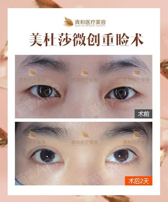 男生割皮后多久好_郑州割双眼皮哪好标准化领_小朋友割皮什么季节好