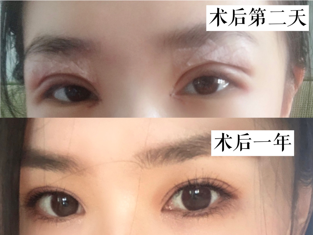 做双眼皮开眼角_做双眼皮的最佳时间点_山东专业做双眼皮的医院
