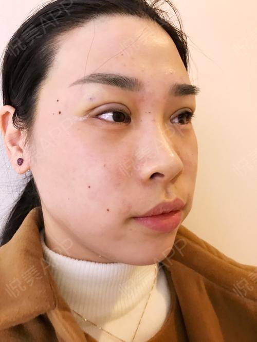 做双眼皮的最佳时间点_山东专业做双眼皮的医院_做双眼皮开眼角