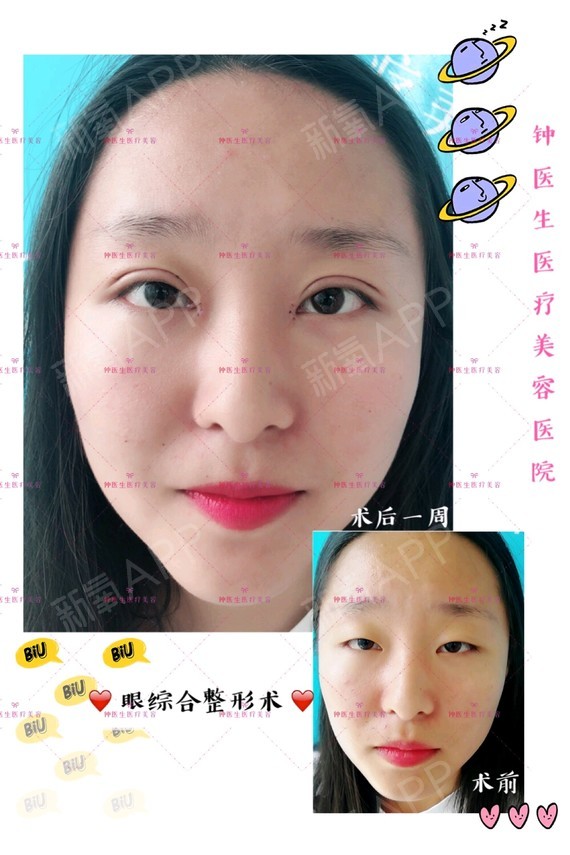 郑州割双眼皮哪好标准化领_北京哪有割双眼皮的_割双眼可以吃草莓吗