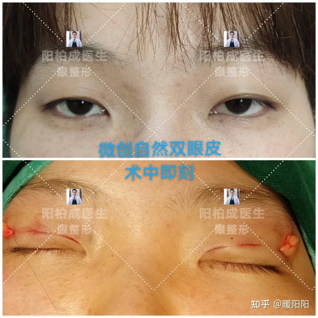 郑州做双眼皮最好专家_二神鼓什么皮做鼓好_郑州做双眼皮最好专家