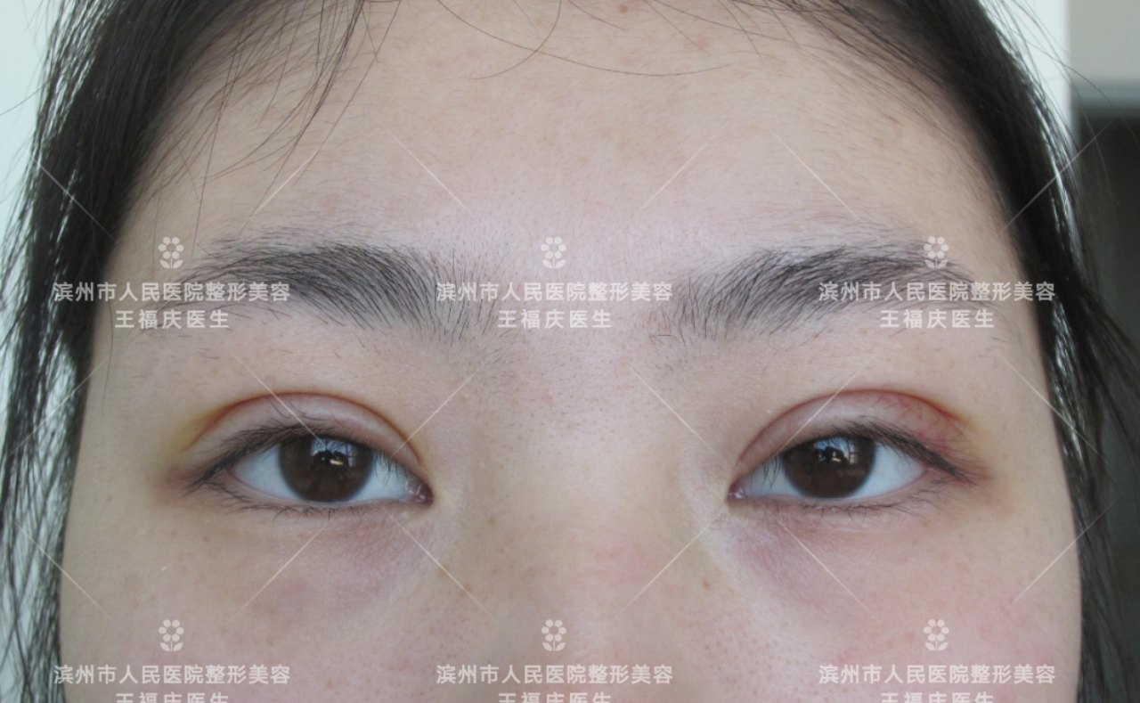 郑州做双眼皮最好专家_袋鼠皮和牛皮哪个做皮鞋好_做云吞皮用什么面粉好