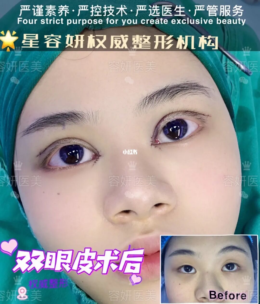 郑州哪位专家做隆鼻好_郑州羊癫疯专家詢康好在线_郑州做双眼皮最好专家