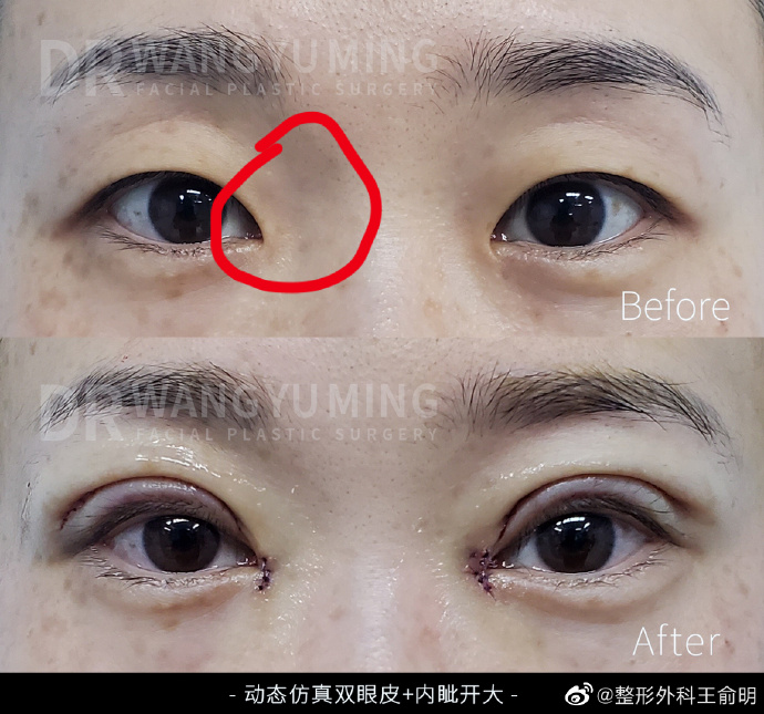 内双做哪种双眼皮好_有没有人内双做双眼皮的_内双种假睫毛好看吗