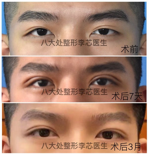 内双做哪种双眼皮好_做云吞皮用什么面粉好_广东哪里做皮秒祛斑好?