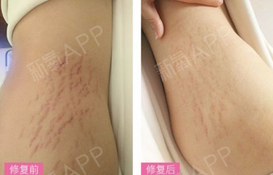 去妊娠纹用什么产品好_去妊娠纹产品_日本人用的去妊娠纹产品