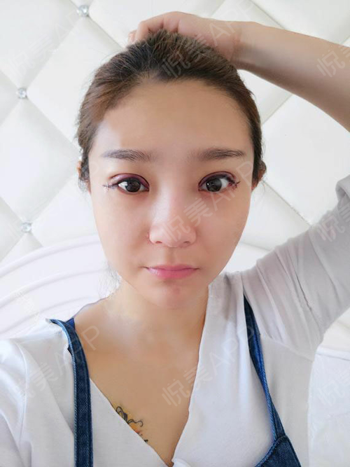 豚鼠皮可以做透皮实验吗_天津哪里可以做双眼皮_天津做双眼皮的医院