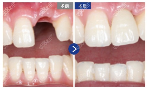 好牙磨小做烤瓷牙图片_种植的牙·推选南宁牙博士_济南种植牙哪里做得比较好